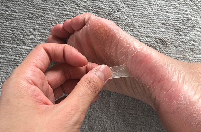 剥ける 皮 指先 の 指の皮がむける原因は？考えられるのはこの4つ！