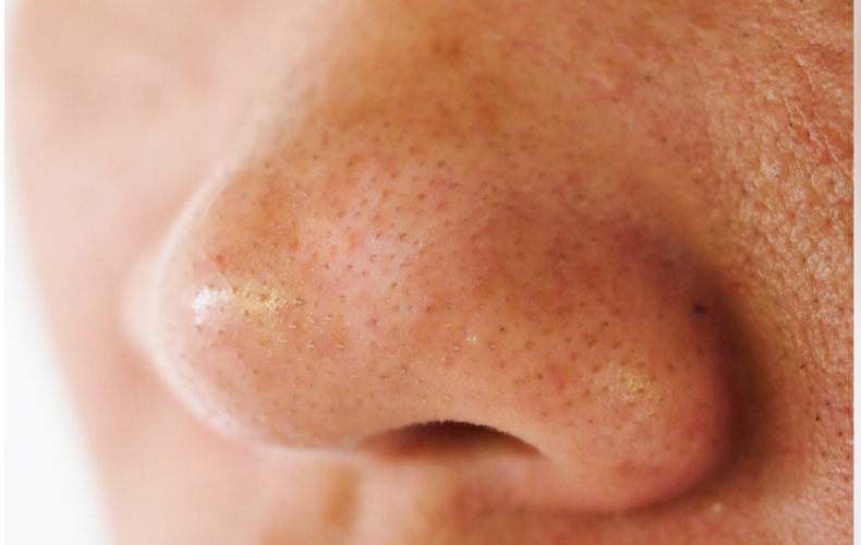 鼻 の 下 の 黒ずみ を 取る 方法