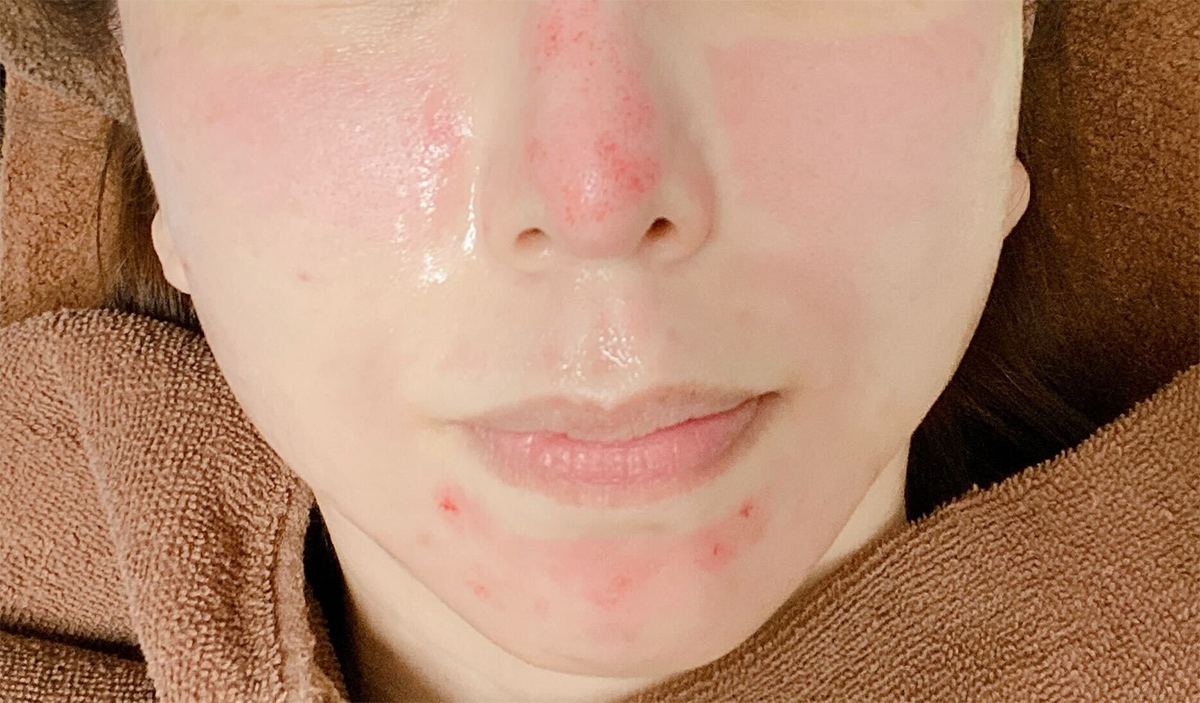 美容医療「ダーマペン」の副反応で赤く腫れた肌