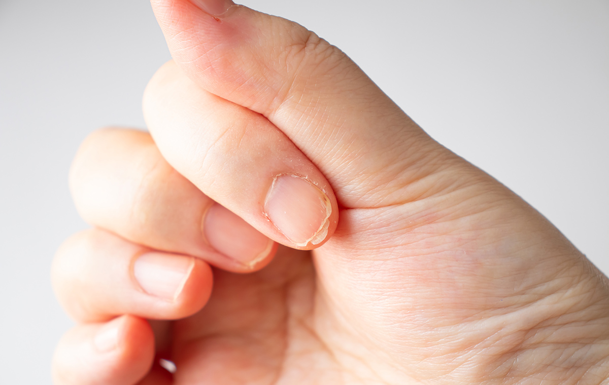 足の爪が剥がれたときの対処法