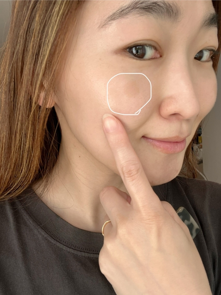 シミの場所を指で指している写真